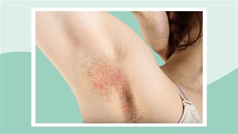 Is It Normal To Get Spots Under Your Armpits