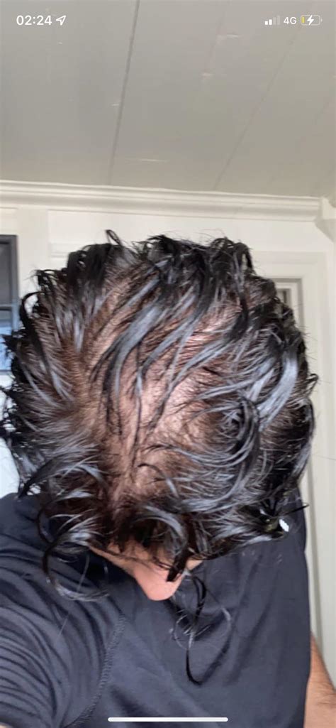 Is It Normal To See Scalp When Hair Is Greasy 