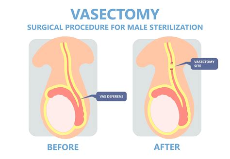 Is It Possible To Have A Kid After A Vasectomy