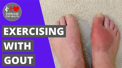 is it safe to exercise with gout