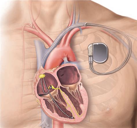 Is It Safe To Use Ultrasound With A Pacemaker