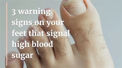 is itchy feet a sign of high blood sugar
