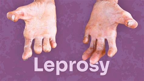 Is Leprosy Curable