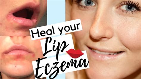 is lip eczema curable