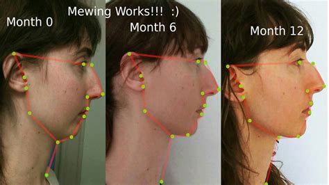 is mewing really work