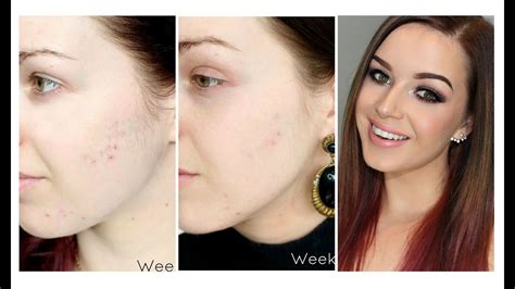 Is Microdermabrasion Good for Acne? The Truth Revealed