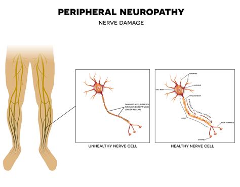 Can Neuropathy Be Reversed? Understanding the Reversibility of Neuropathy Symptoms
