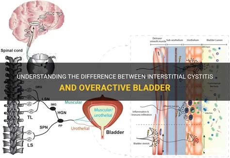 Is Overactive Bladder The Same As Ic