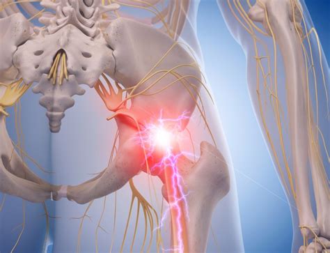 is pregabalin good for sciatica