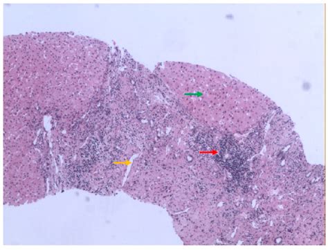 is primary biliary cholangitis associated with ulcerative colitis