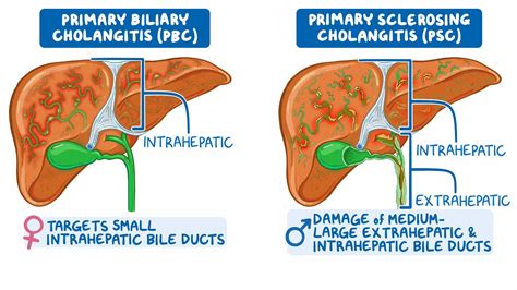 is primary biliary cholangitis fatal