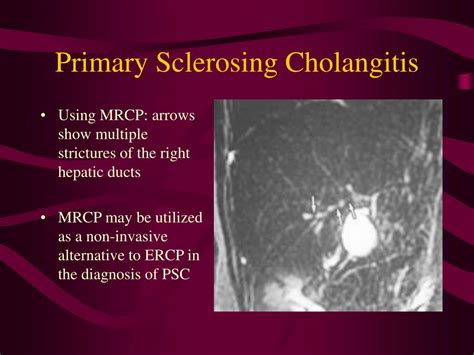 is primary sclerosing cholangitis associated with ulcerative colitis