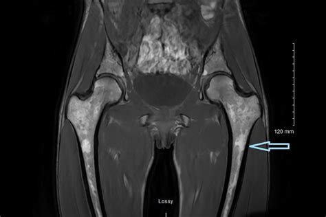 is red marrow reconversion dangerous