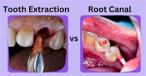 Is Root Canal Tooth Extraction