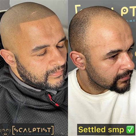 is scalp micropigmentation noticeable
