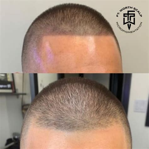 is scalp micropigmentation worth it reddit