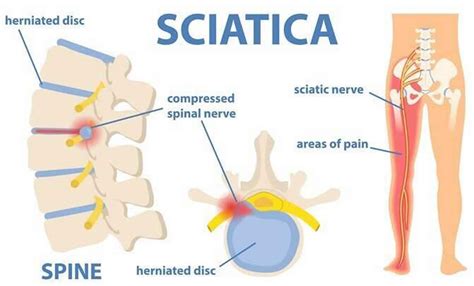 Is Sitting Bad For Sciatica