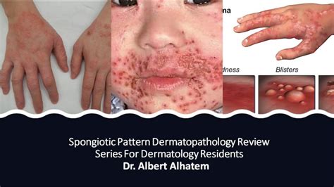 is spongiotic dermatitis an autoimmune disease