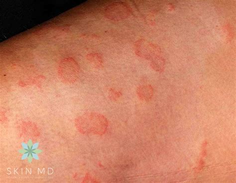 Is Sweat Rash Fungal
