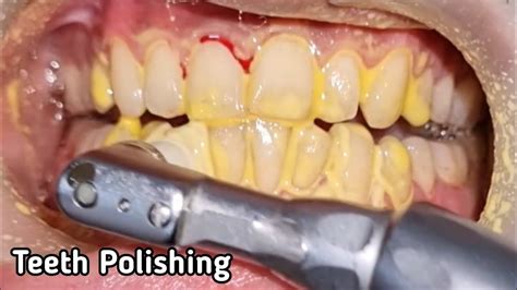 Is Teeth Polishing Bad