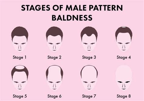Is There A Way To Prevent Male Pattern Baldness 