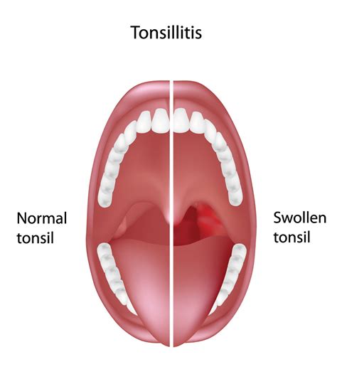 is tonsillitis contagious in children