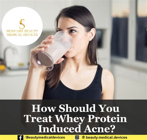 is whey protein safe for acne