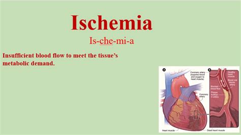 ischemia meaning
