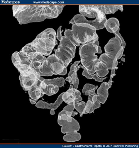 Ischemic Colitis Medscape