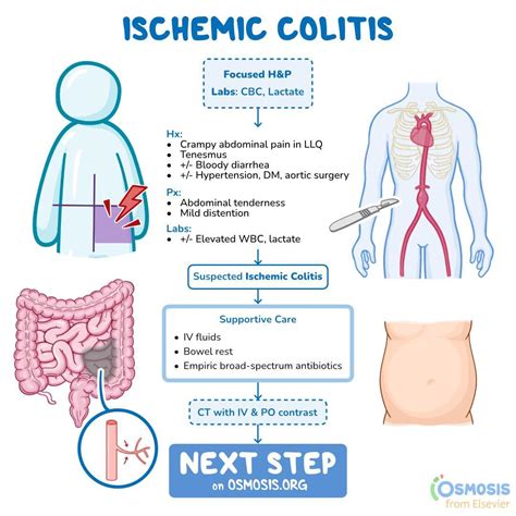 Ischemic Colitis Young Age
