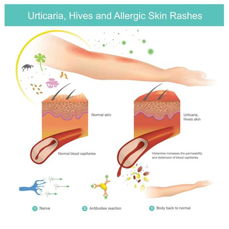 Itching Hives Causes