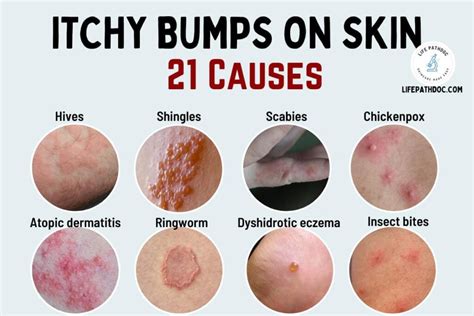 itchy bumps on skin cream