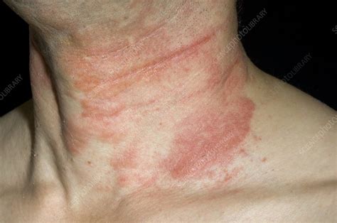 itchy burning rash on face and neck