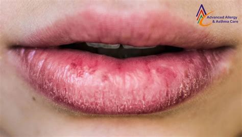 Itchy Lips Hives