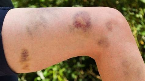 itp and bruising