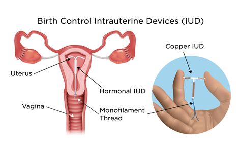 Exploring the IUD Contraceptive Method: Safety and Effectiveness