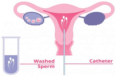 iui treatment for pregnancy