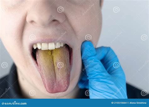 Yellow tongue Causes and Treatments