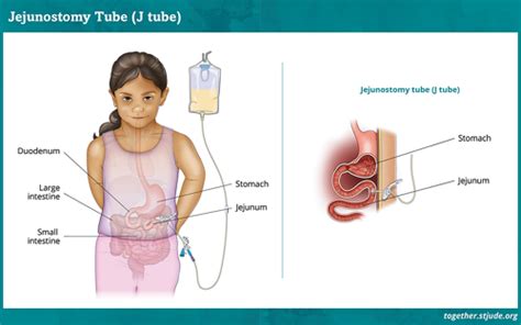 J-Tube Replacement Procedure
