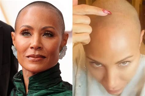 jada pinkett smith doesn't have alopecia