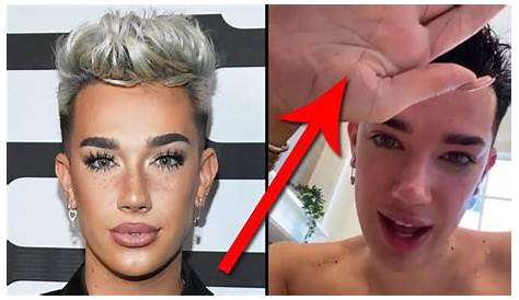 Unveiling James Charles' Hair Loss: Groundbreaking Insights And Solutions