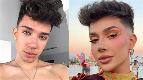 James Charles Botox