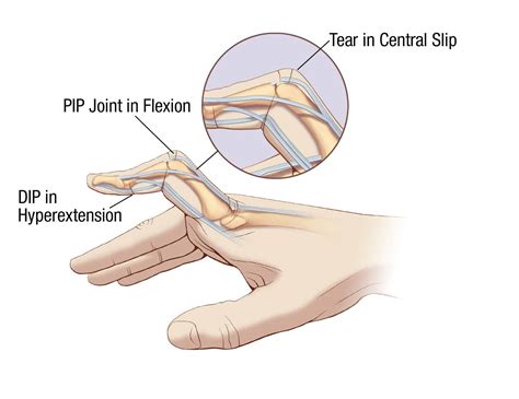 Jammed Finger Deformity