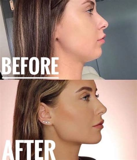 jaw exercise before and after woman
