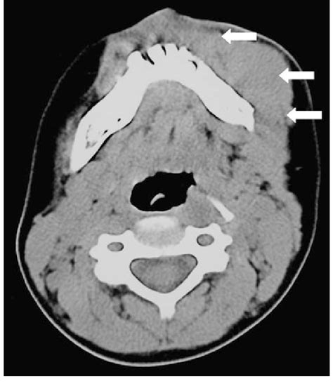 Jaw Muscles Ct