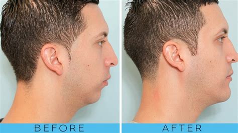 jawline exercise before and after
