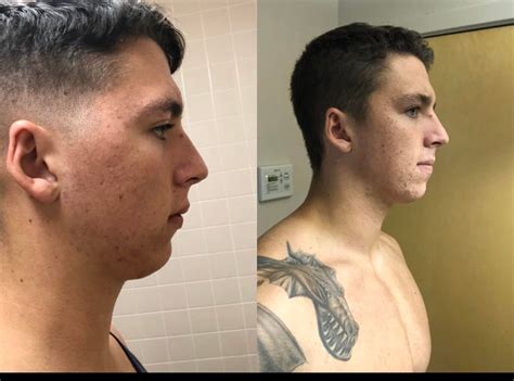 jawline exercises before and after reddit