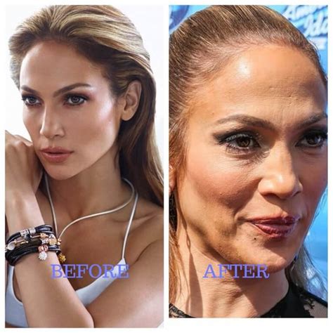 jennifer lopez plastic surgery 2024