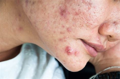 Uncover the Secrets of Soothing Itchy Acne