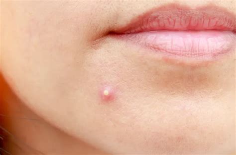 Jerawat Batu Matang: Atasi dengan Cara Ini Sebelum Meninggalkan Bekas